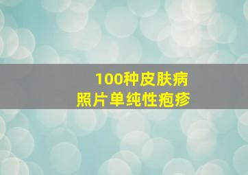 100种皮肤病照片单纯性疱疹